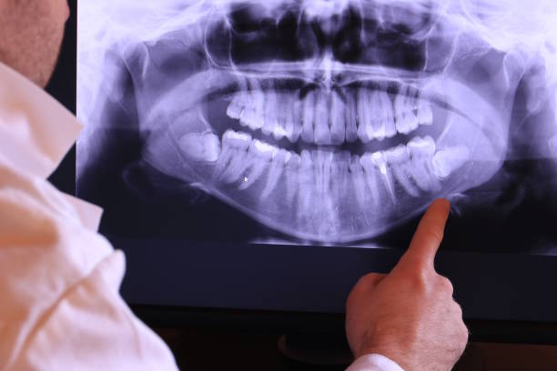 Best Emergency Wisdom Teeth Removal in West Miami, FL